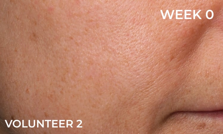 Reduction in forehead wrinkles before