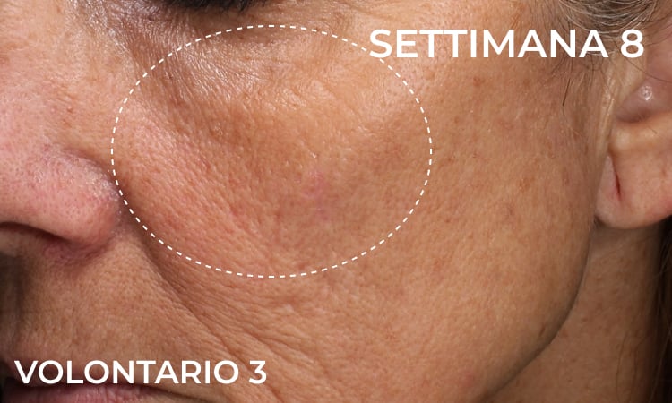 Dopo 8 settimane di applicazione