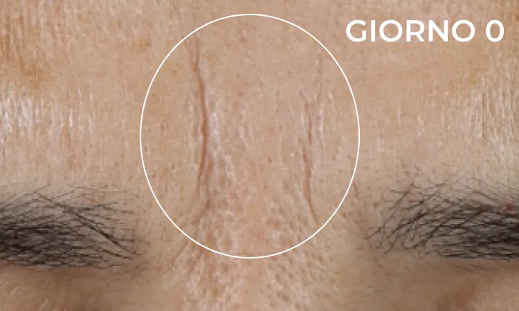 Reduction in neck lines before