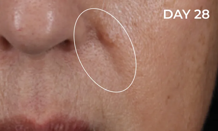 Reduction in neck wrinkles before