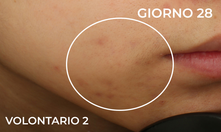 Volontario 2 - dopo 28 giorni di trattamento (pelle più uniforme e purificata)