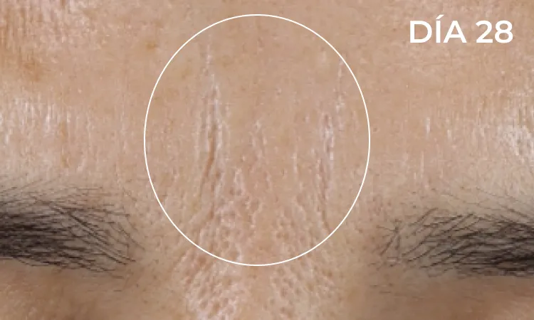 Reduction in neck lines after