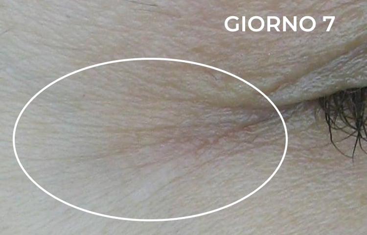 Riduzione della piega nasolabiale dopo