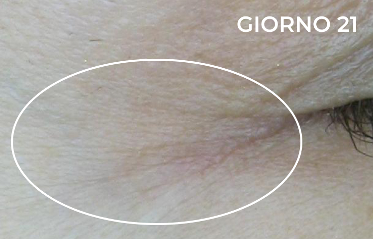 Riduzione della piega nasolabiale dopo