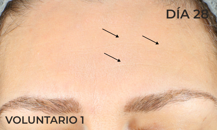 Foto demostrando la reducción de arrugas de la frente después de la aplicación de producto