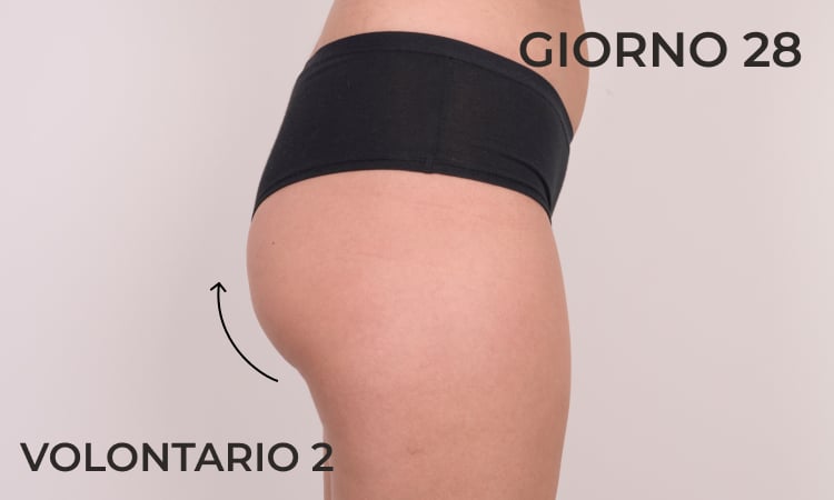 Lift dei glutei dopo