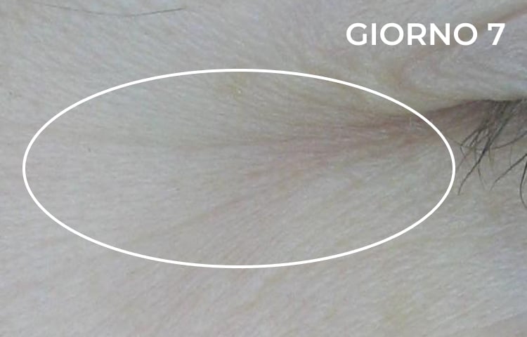 Riduzione della piega nasolabiale dopo