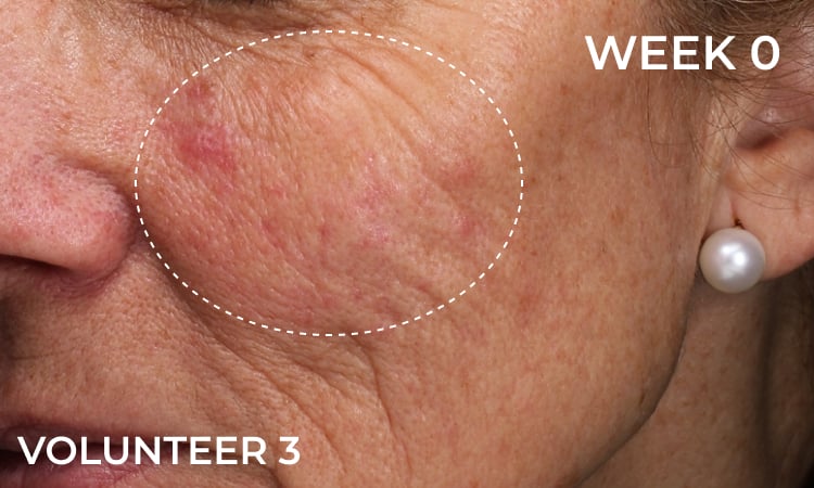 Reduction in forehead wrinkles before