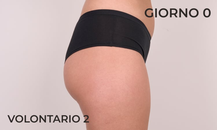 Lift dei glutei prima
