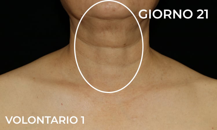 Riduzione delle rughe del collo dopo