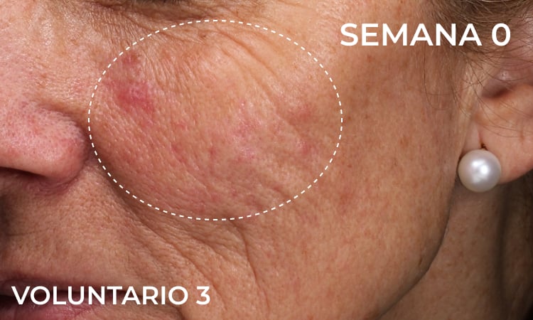 Reduction in forehead wrinkles before