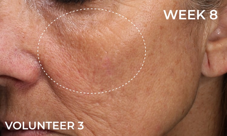 Reduction in forehead wrinkles before