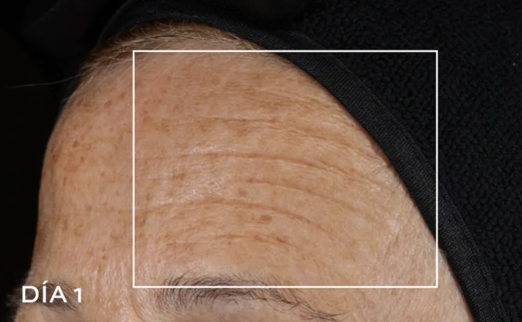 Foto de antes de una frente con visibles arrugas